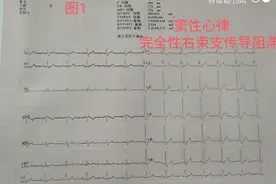 完全性右束支传导阻滞图片