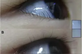 孩子眼白变蓝说明贫血？确实有可能，但你需要先了解这些图片