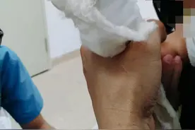 11个月大女婴拆石膏时一截手指被医生剪断，家长：断指已再植，医院：深感痛心和歉意，当事医生已离职图片