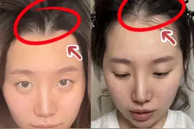 自用无广！！发量问题有救啦！#米诺地尔#亲测有效#摆脱掉发图片