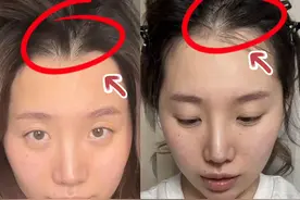 自用无广！！发量问题有救啦！#米诺地尔#亲测有效#摆脱掉发图片
