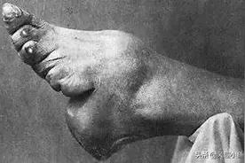 历史的最大糟粕，中国古代妇女的酷刑——“三寸金莲”图片