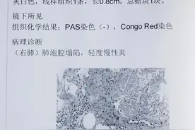 磨玻璃结节肺癌穿刺活检准确吗？又一例眼睛PK赢穿刺病理图片