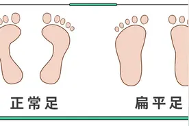 孩子扁平足，伴随这几种异常！有脊柱侧弯、驼背的风险图片