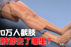 我国有170万人截肢，他们的断肢都怎么处理？答案或超乎你的想象图片