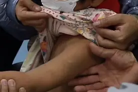 孩子右臂血管畸形非常严重，不及时治疗手的功能都会受影响图片