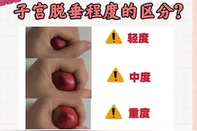 【划重点】子宫脱垂？一文教你识别轻中重度！图片