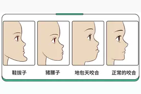 想趁放假给孩子矫正牙齿？弄懂这3个问题，你再行动！图片