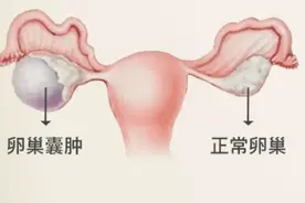 妇女节的关爱——聊聊卵巢囊肿图片