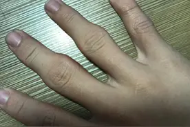 13岁孩子手指关节软组织肿大是怎么回事？图片