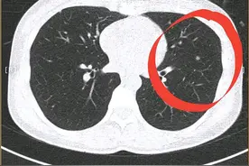 肺部有癌，睡眠先知？睡觉出现4种异常，可能是癌症发出的信号图片