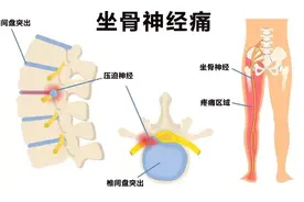 为什么会坐骨神经痛？怎么预防坐骨神经痛？图片