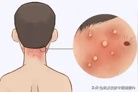 头皮上长了个脓包，好了后掉了一片头发是怎么回事呢图片