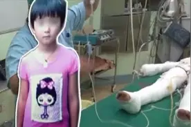 河南8岁女孩患怪病，发病三天全身表皮100%脱落，父母心如刀绞图片