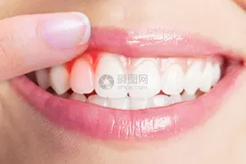 牙龈肿痛发炎怎么办？医生告诉你快速止痛办法图片