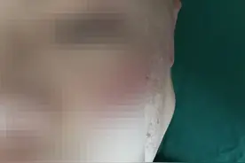 男子左耳垂部肿块“久居”十年 原是腮腺肿瘤！图片