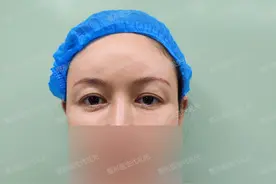 43岁女士来北京做了筋膜悬吊提眉手术，术后2周高清照片对比图片