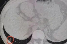朱医生自己的磨玻璃结节消失了图片