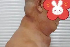 酒而久之 招惹来罕见病“马德龙”图片