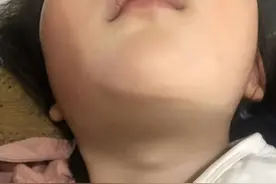 什么是甲状舌管囊肿（一）图片