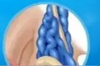 精索静脉曲张到底要不要手术？图片