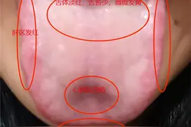 今日患者舌象分析—— 经常心慌、心跳加快 失眠多梦、脾气急易发火图片