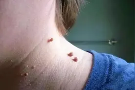 皮肤上的小肉球、小肉疙瘩是什么？不出意外，这4种可能性较大图片