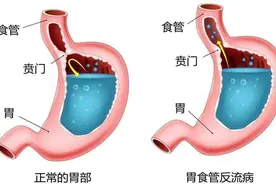 什么是胃食管反流、反流性食管炎？胃镜能不能检查出胃食管反流？图片