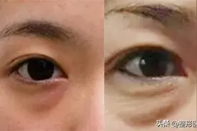 眼周衰老怎么解决，医生说这6个项目还不错，年轻好几岁图片