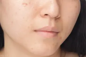 正确的祛斑方法是什么呢？图片