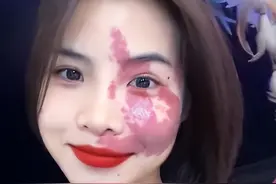 广东，年轻漂亮女子脸上长胎记，阳光自信有魅力：天使之吻！图片