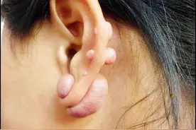 打耳洞长了疤痕疙瘩怎么办？图片