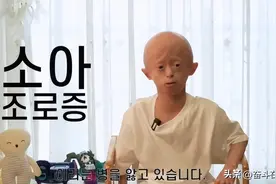 韩国唯一小儿早衰症患者：每天都是人生最后一天，所以要开心过图片