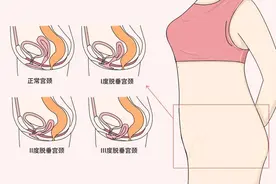 阴挺是什么病？主要原因是什么？女性要远离这种社交癌图片