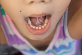 为什么牙齿不掉，医生叫我拔了？图片