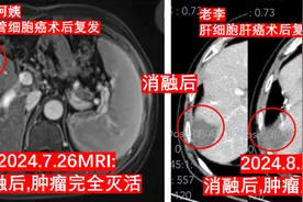 消融治疗：又一次快速消灭肝癌图片