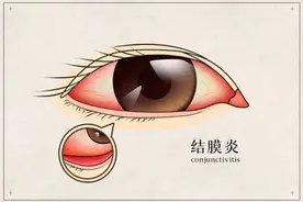孩子眼睛突然红肿、瘙痒，是不是得了过敏性结膜炎？图片