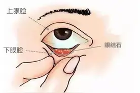 眼睛里长“石头”？图片