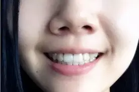 戴牙套真的要三思，医生绝不会告诉你有这些后遗症图片