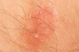 面部皮炎面面观图片