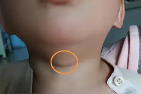 孩子颈部正中的“疙瘩”，有可能是它惹的祸！图片