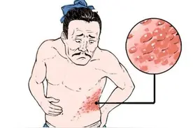 它是“缠腰龙”克星，保护效力超90%！已经得过这种病的人还要打吗？图片