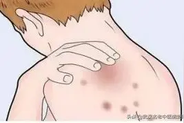 皮肤痒痒的一抓就更痒然后起疙瘩用什么药图片