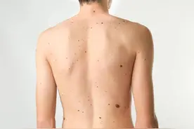 身上长这种痣的人肝多半不好！赶紧对镜自查，别等肝癌上身才后悔图片