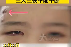长痘别乱挤！13岁女孩挤痘痘导致败血症图片
