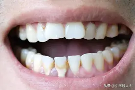 牙缝里的牙结石，怎么清理干净？2个有效方法，还你一口干净牙齿图片