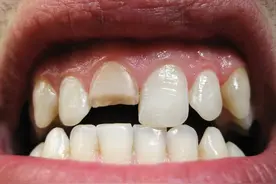 牙齿裂开该如何修复？图片