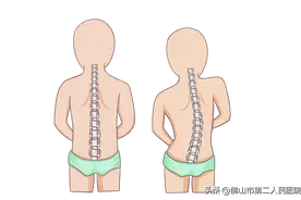 青少年脊柱侧弯，中医外治助力孩子挺起脊梁图片