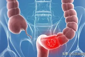 早期直肠肿瘤的症状？早期直肠肿瘤术后能活多少年图片