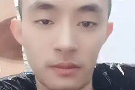 植发一年零两个月效果图片